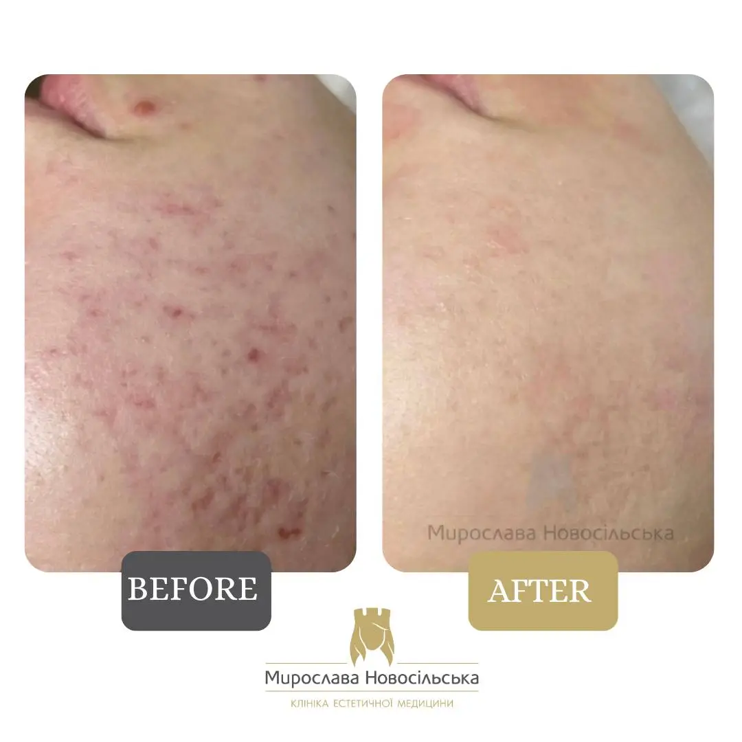 Laser resurfacing of scars and post acne