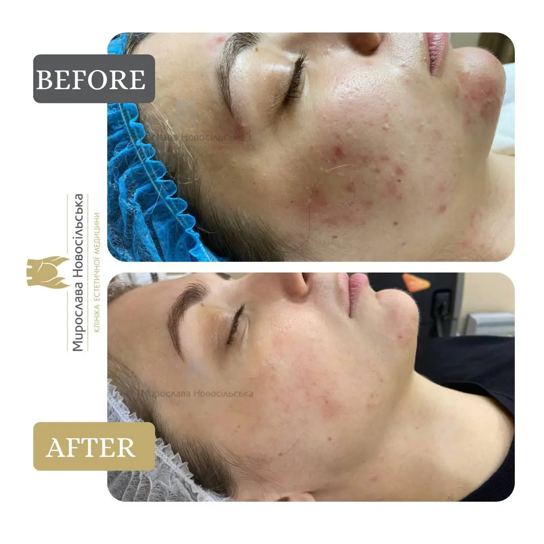 Laser acne treatment