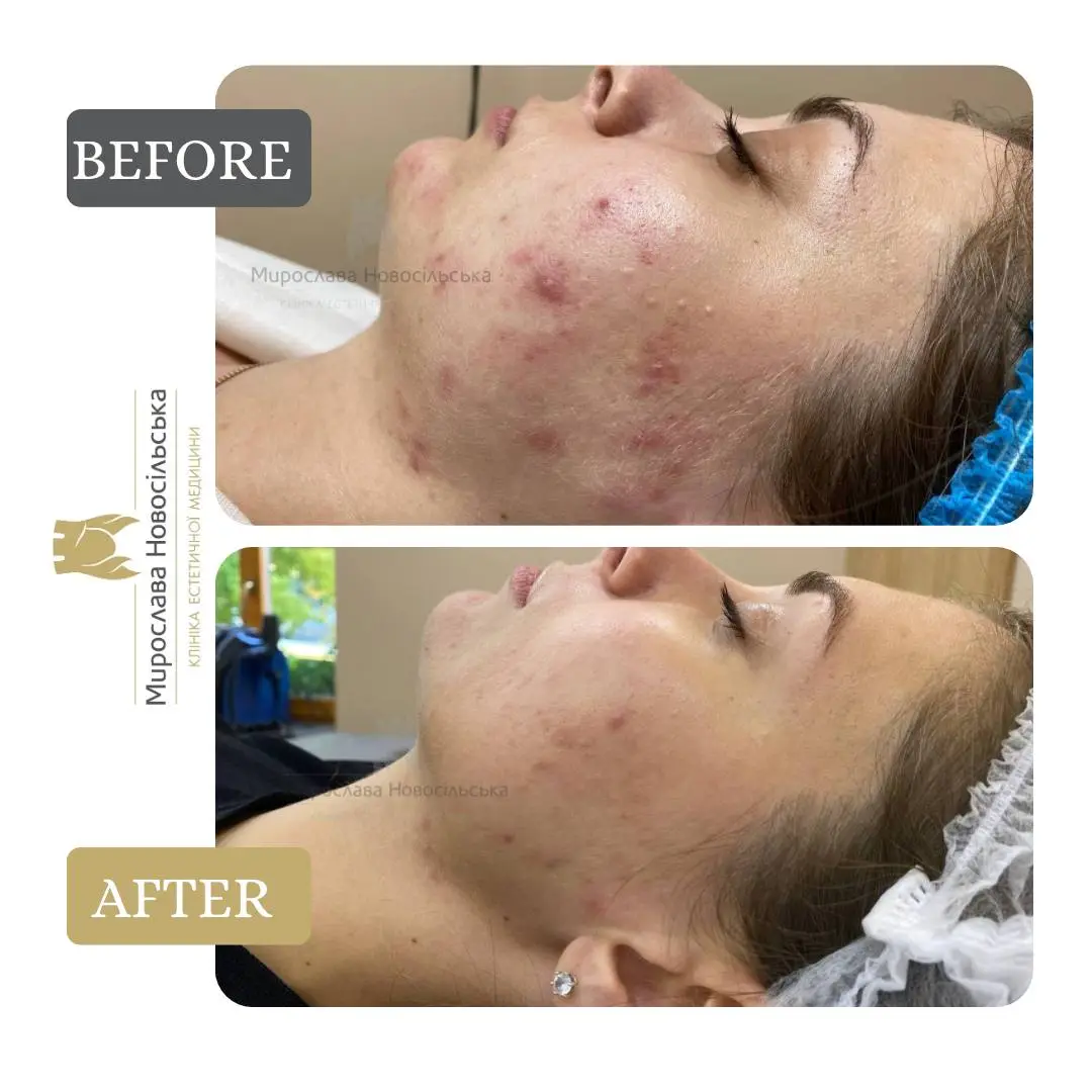 Laser acne treatment