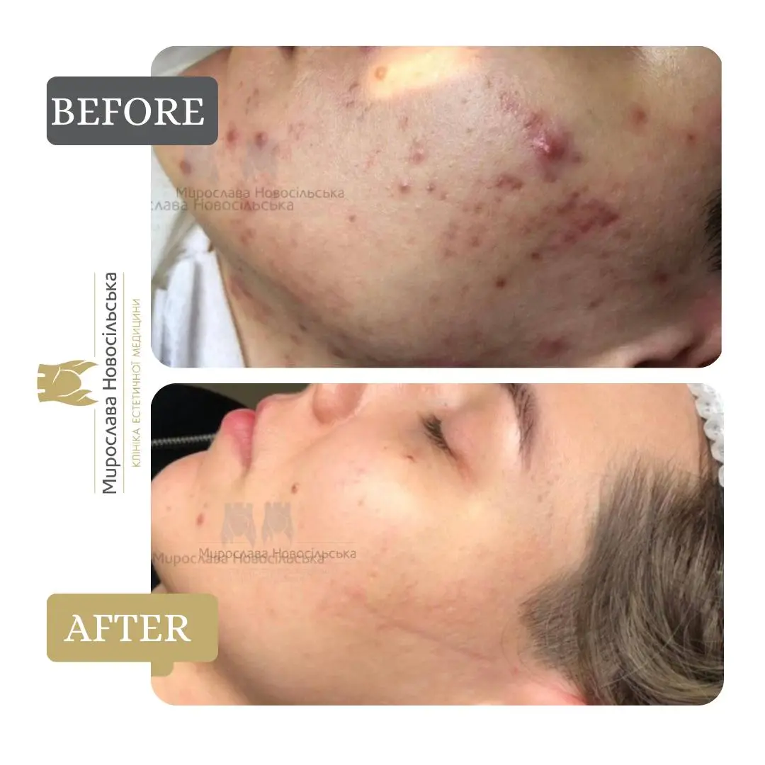Laser acne treatment