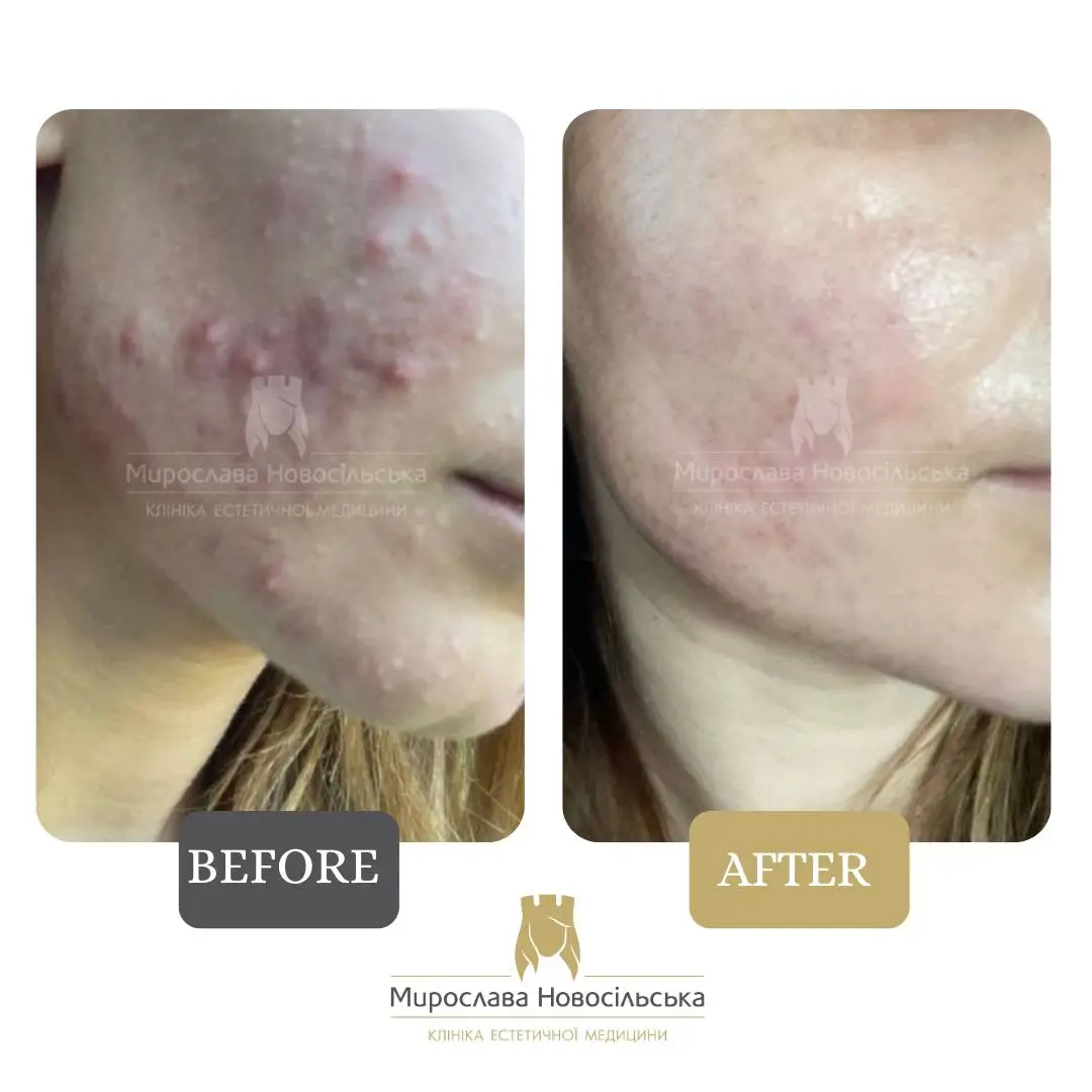 Laser acne treatment