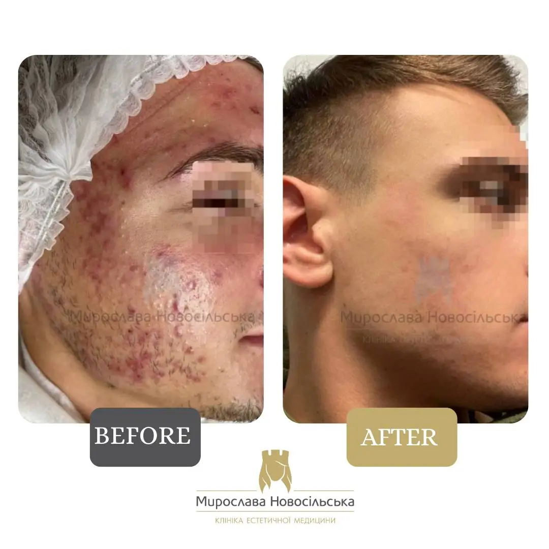 Laser acne treatment