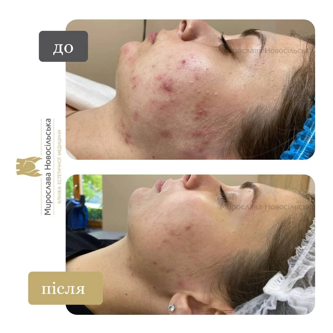 Лазерне лікування акне у Львові, фото 3