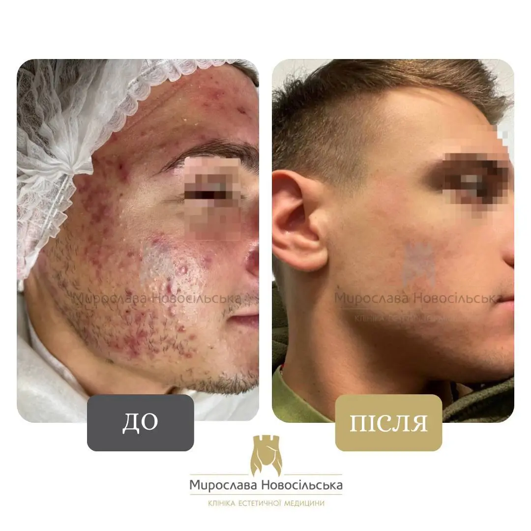 Лазерне лікування акне у Львові, фото 8