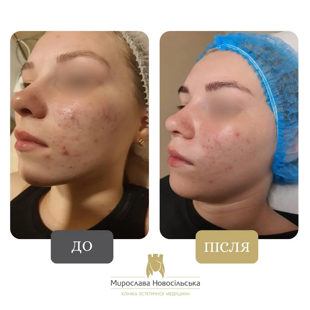 Лазерне лікування акне у Львові, фото 9