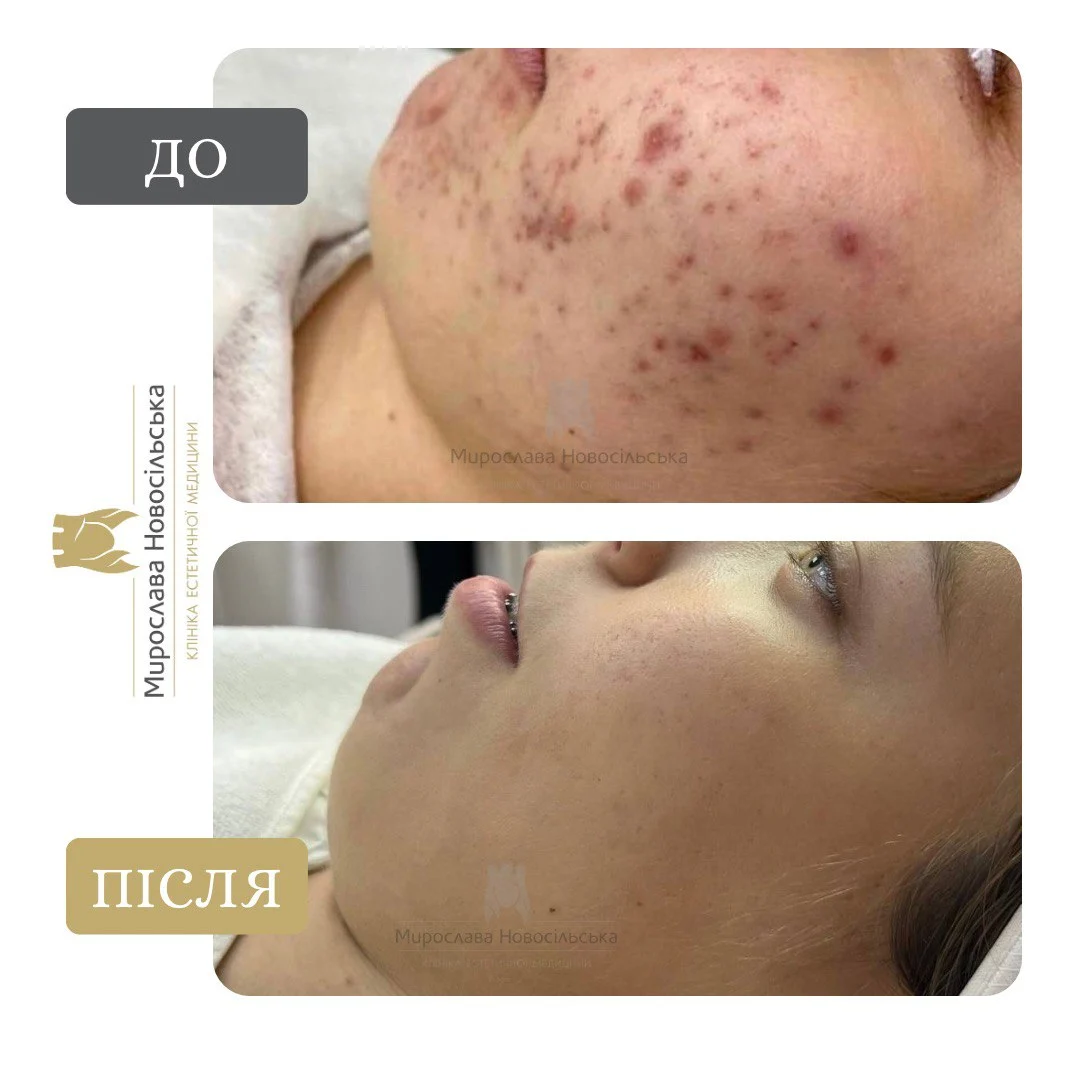 Лазерне лікування акне у Львові, фото 4