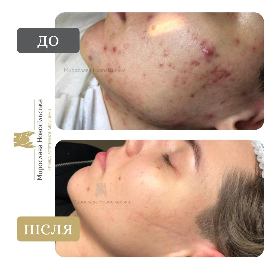 Лазерне лікування акне у Львові, фото 5