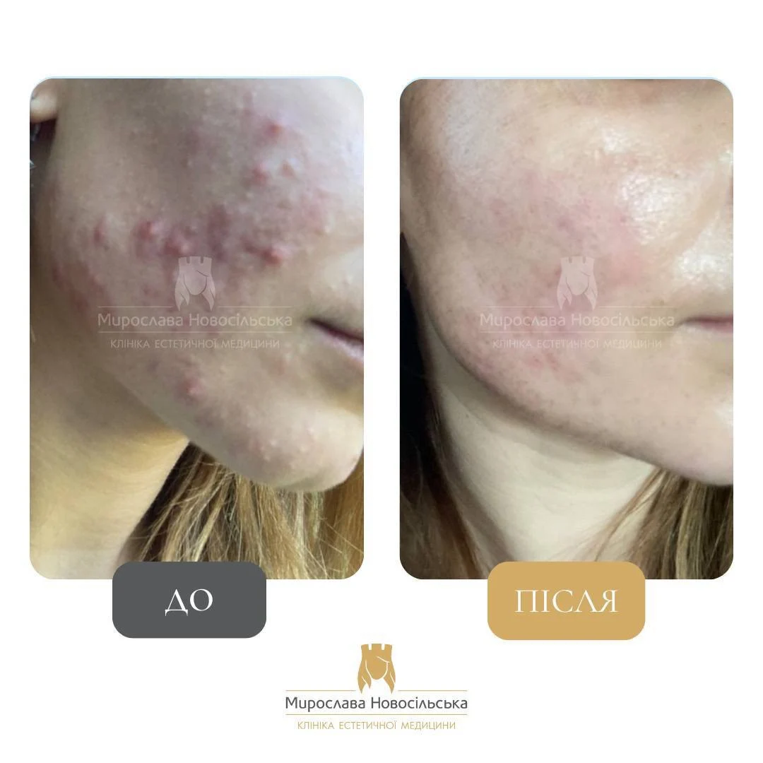 Лазерне лікування акне у Львові, фото 6