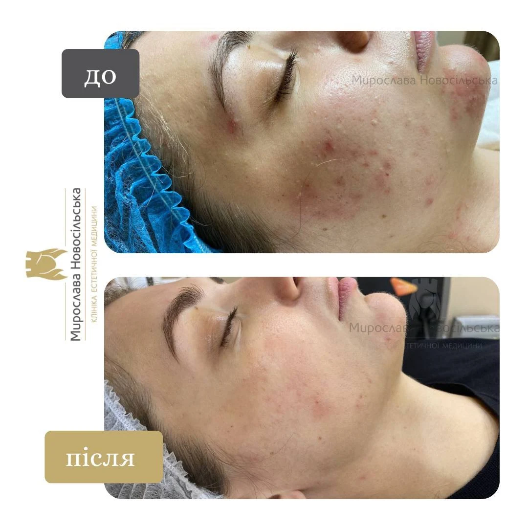 Лазерне лікування акне у Львові, фото 2
