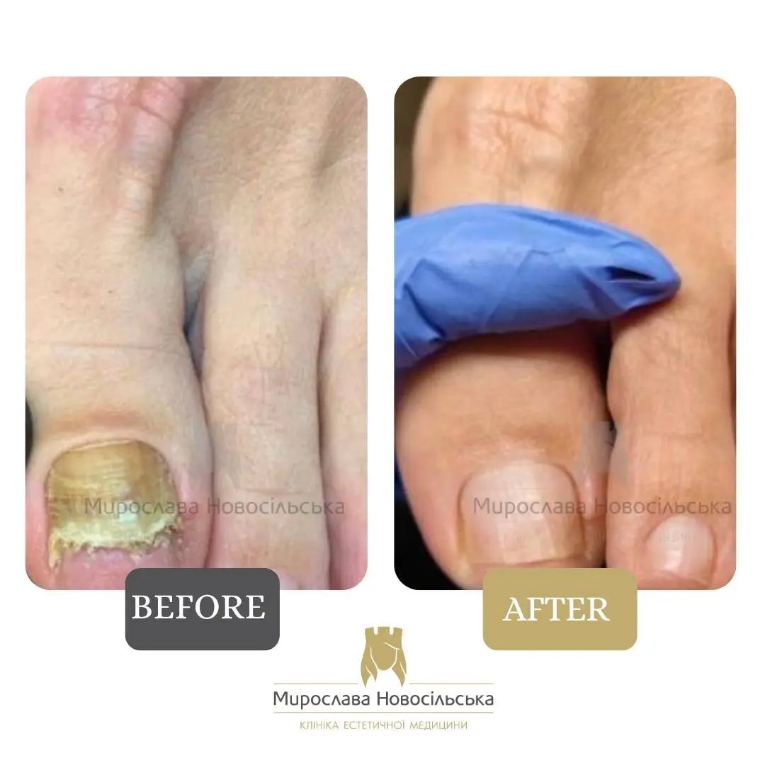 Fungus laser treatment, photo 17