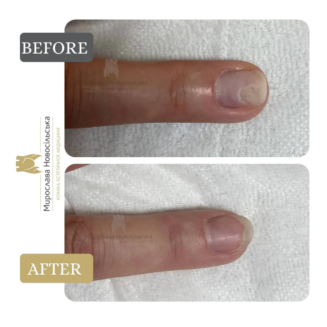 Fungus laser treatment, photo 18