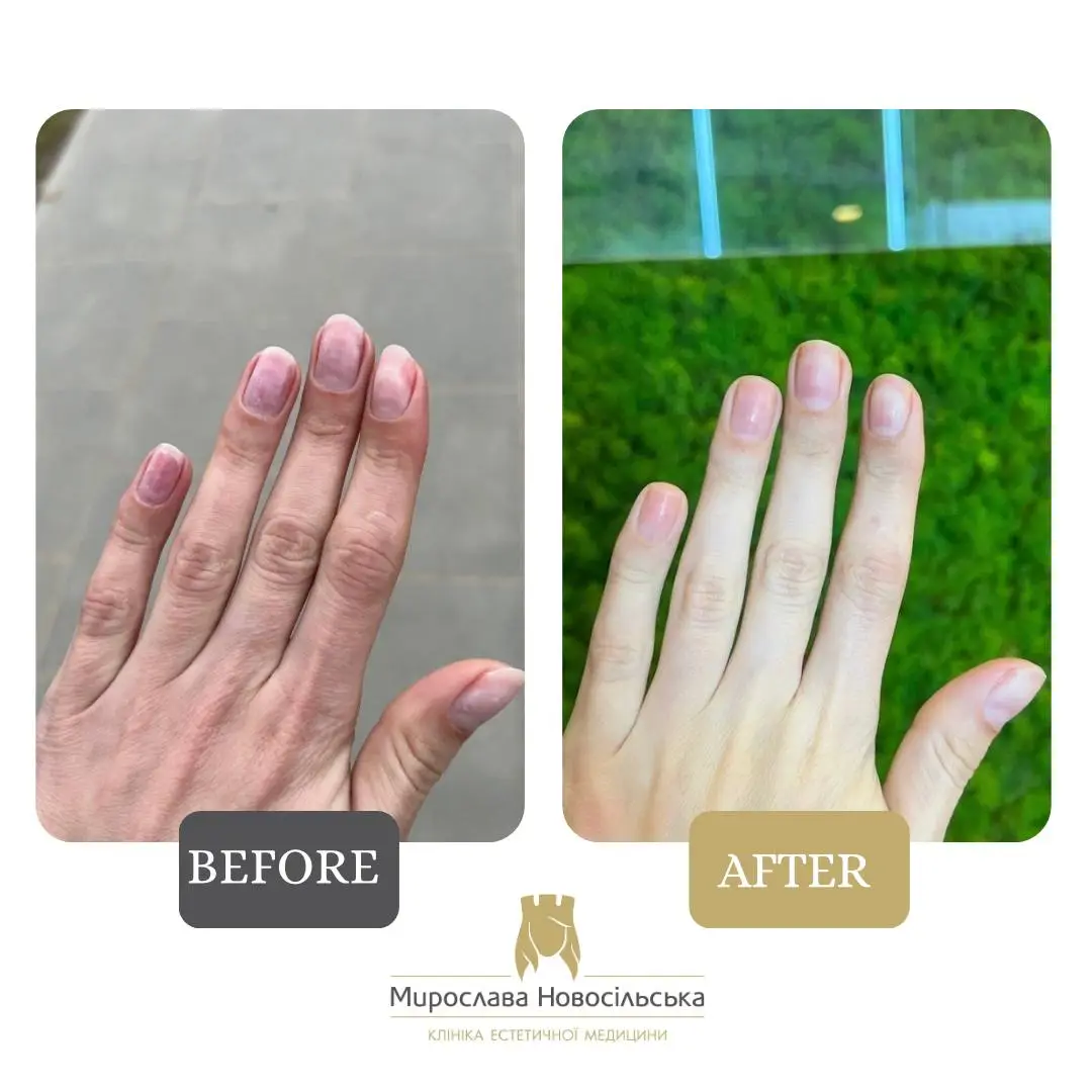 Fungus laser treatment, photo 12