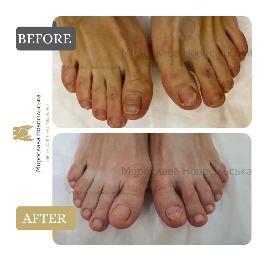 Fungus laser treatment, photo 9