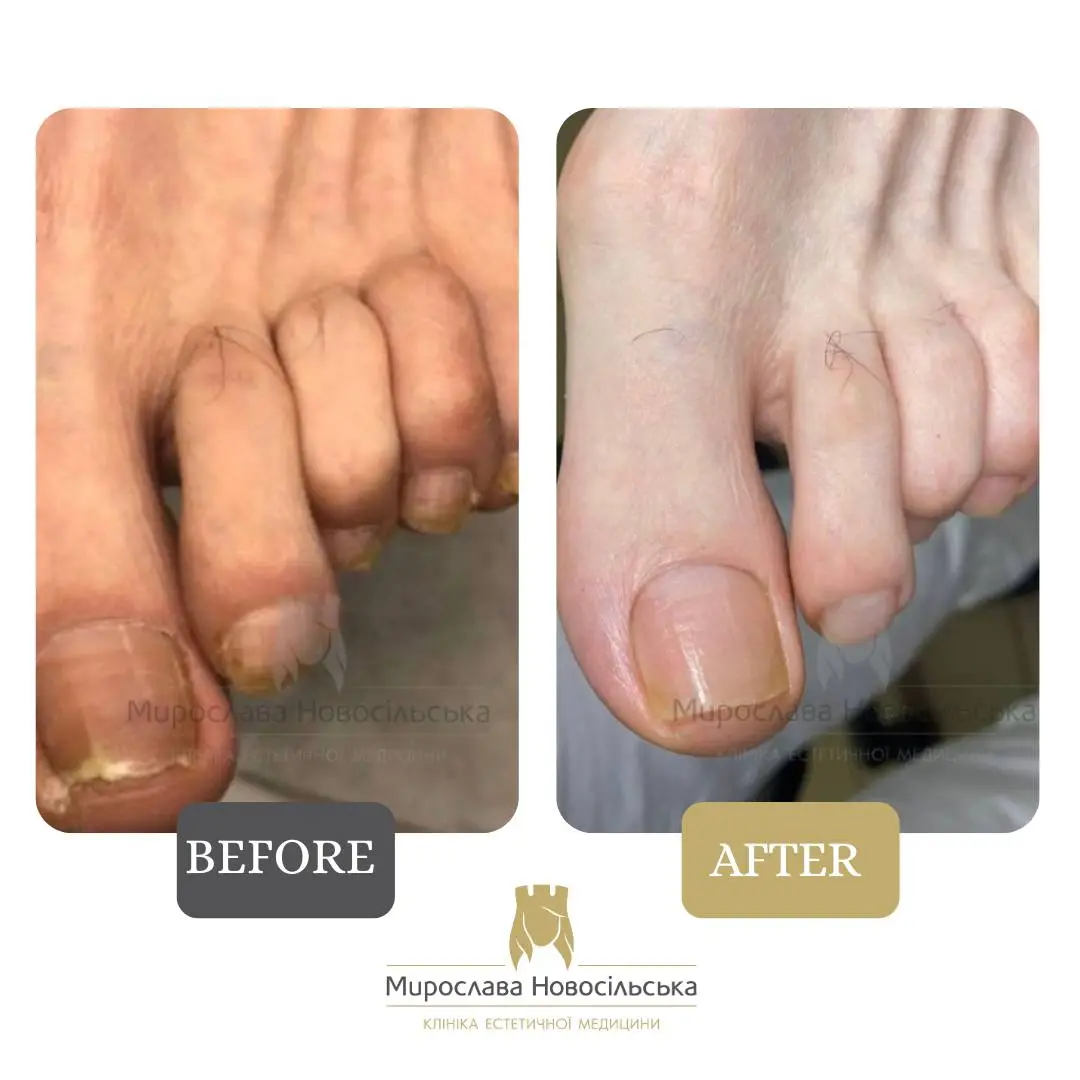 Fungus laser treatment, photo 13