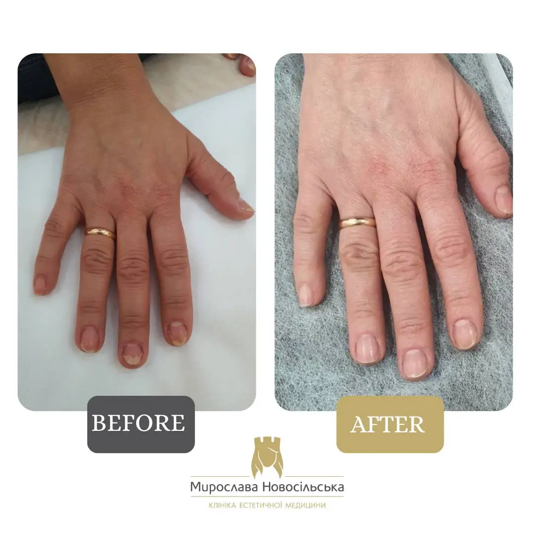 Fungus laser treatment, photo 10