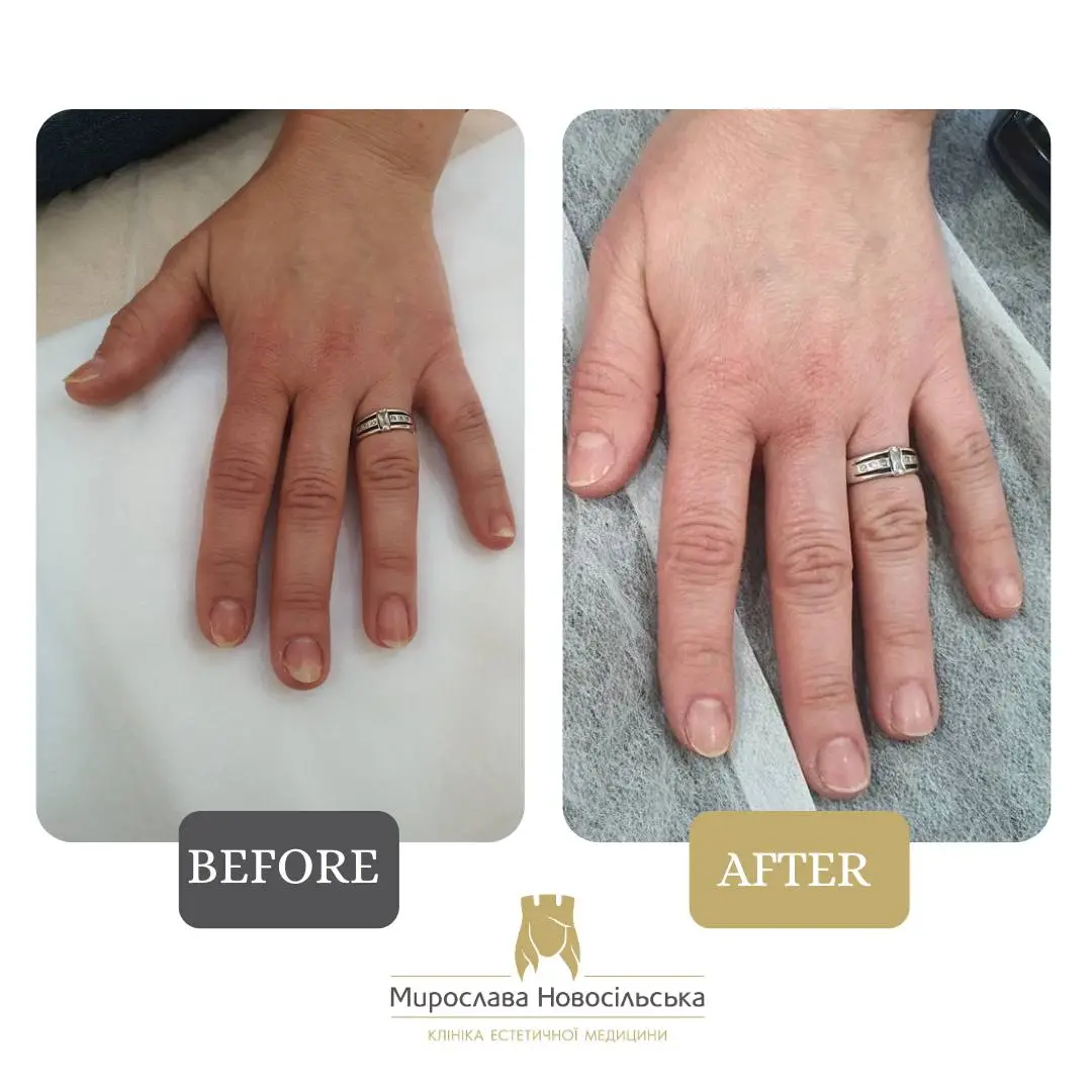 Fungus laser treatment, photo 11