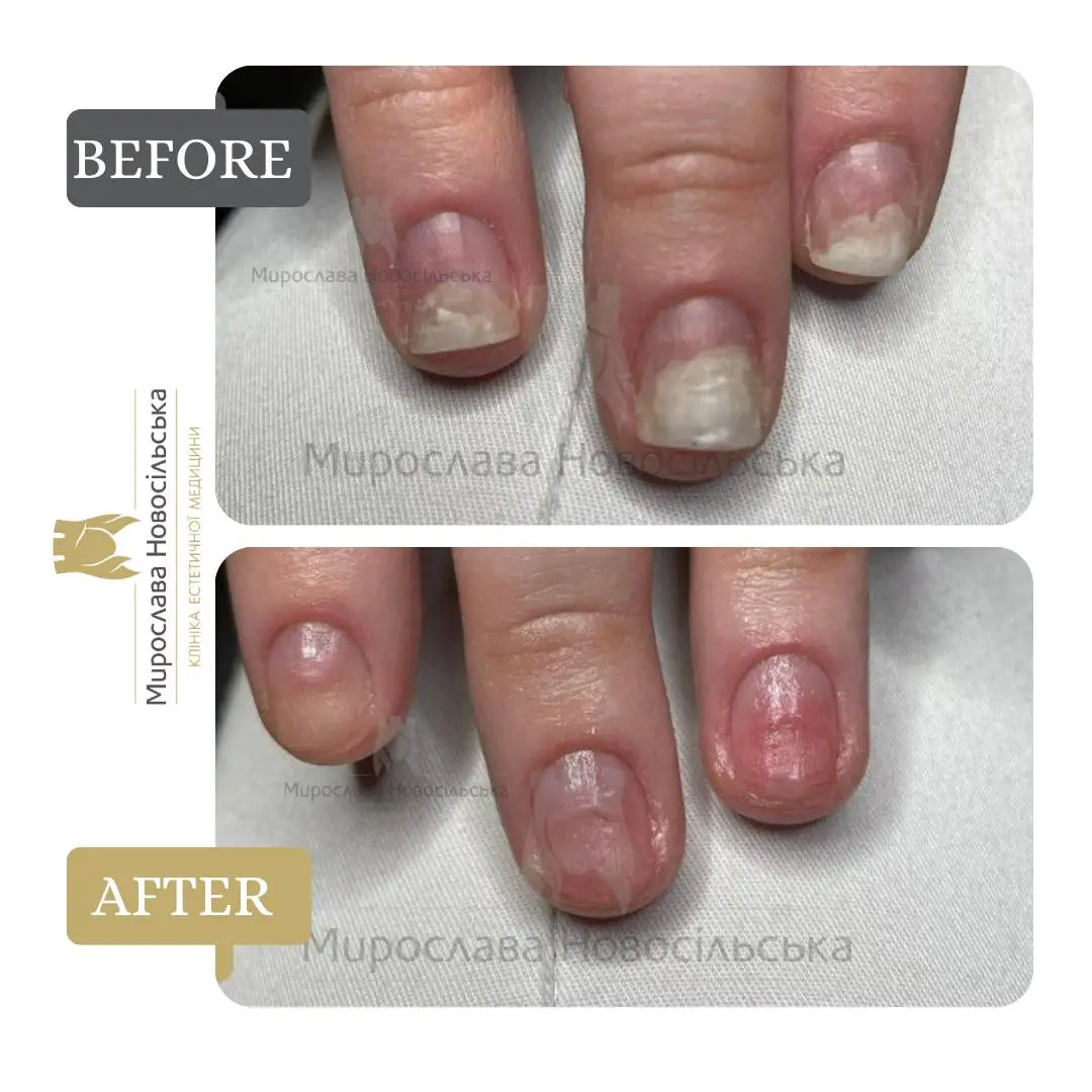 Fungus laser treatment, photo 14