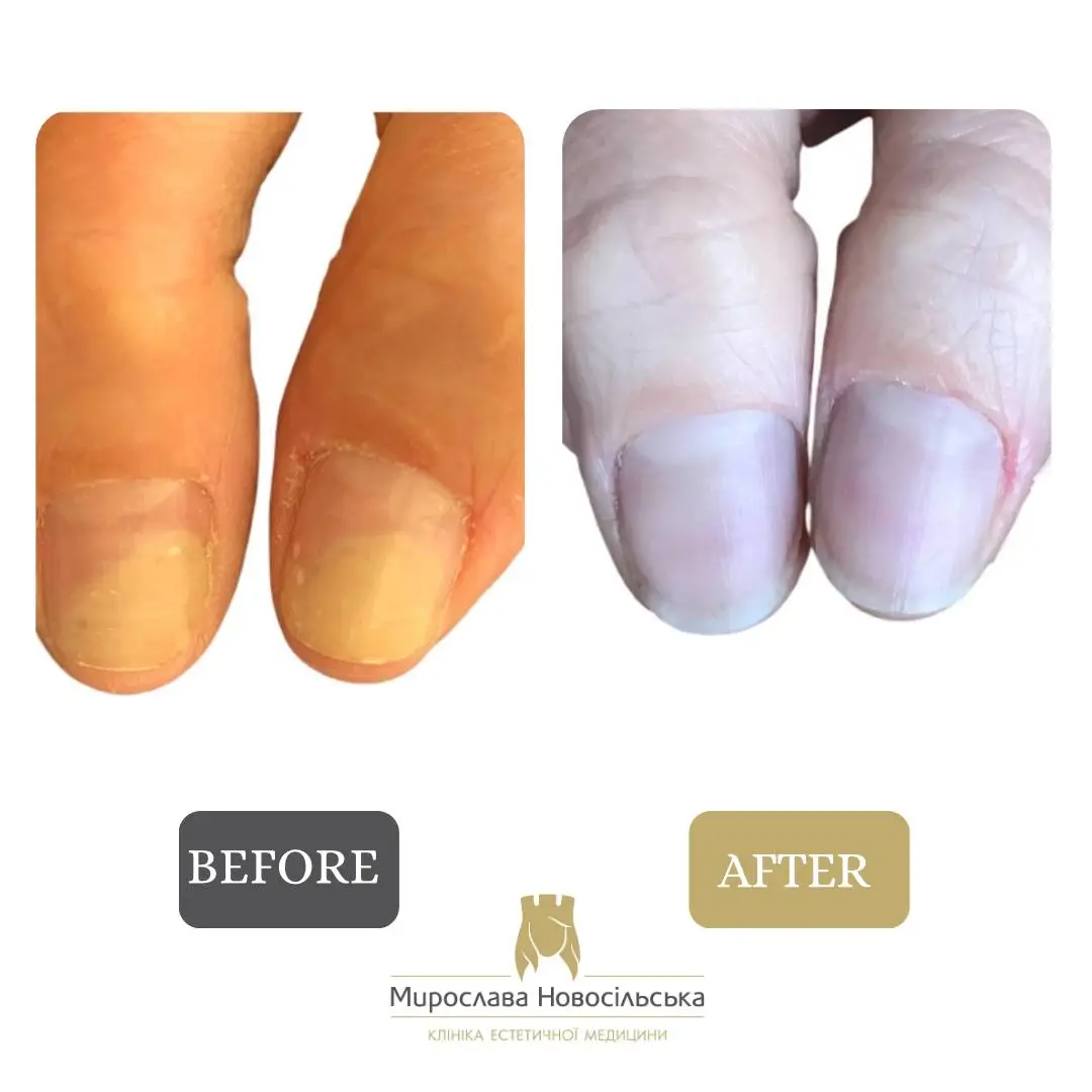 Fungus laser treatment, photo 16