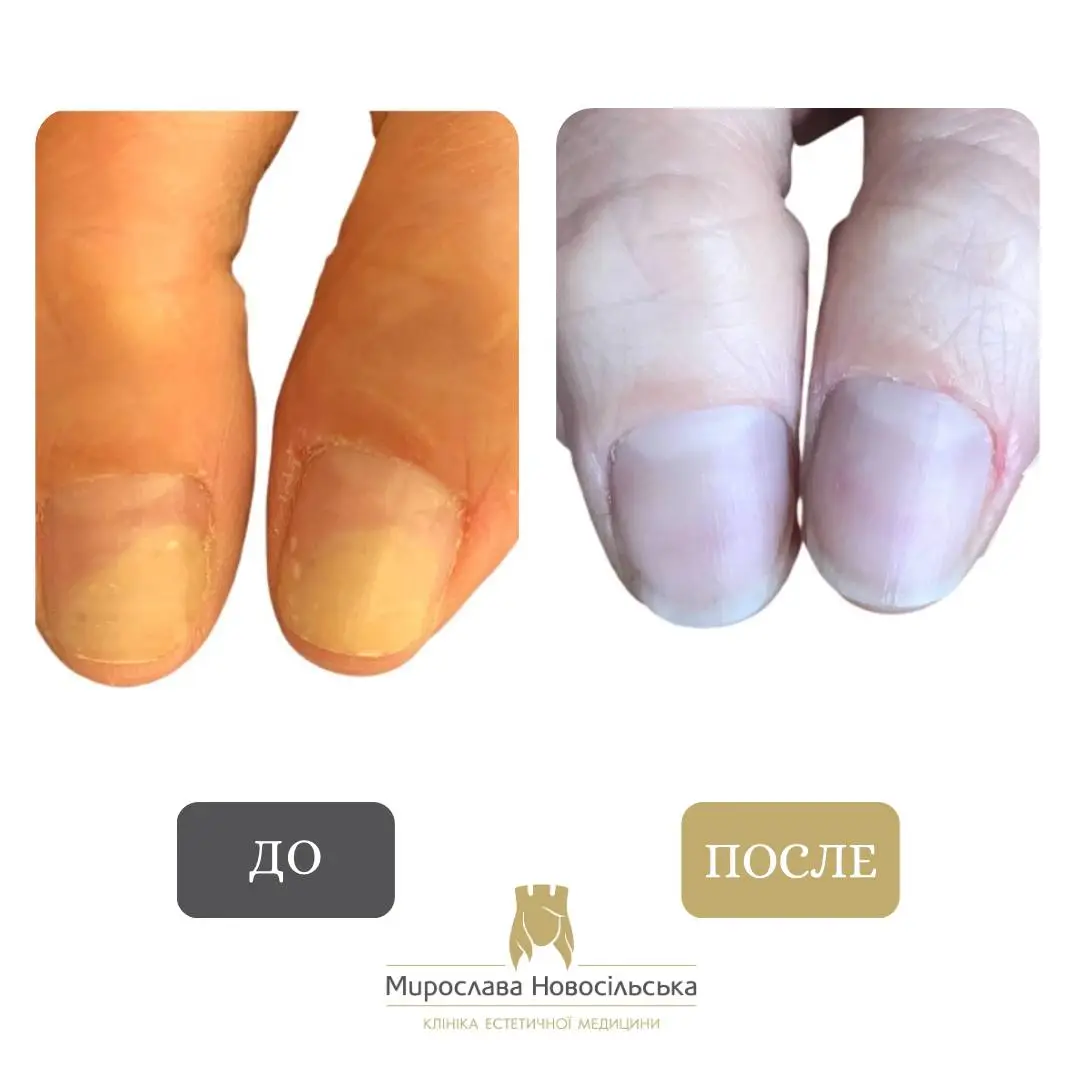 Лазерное лечение грибка, фото 16