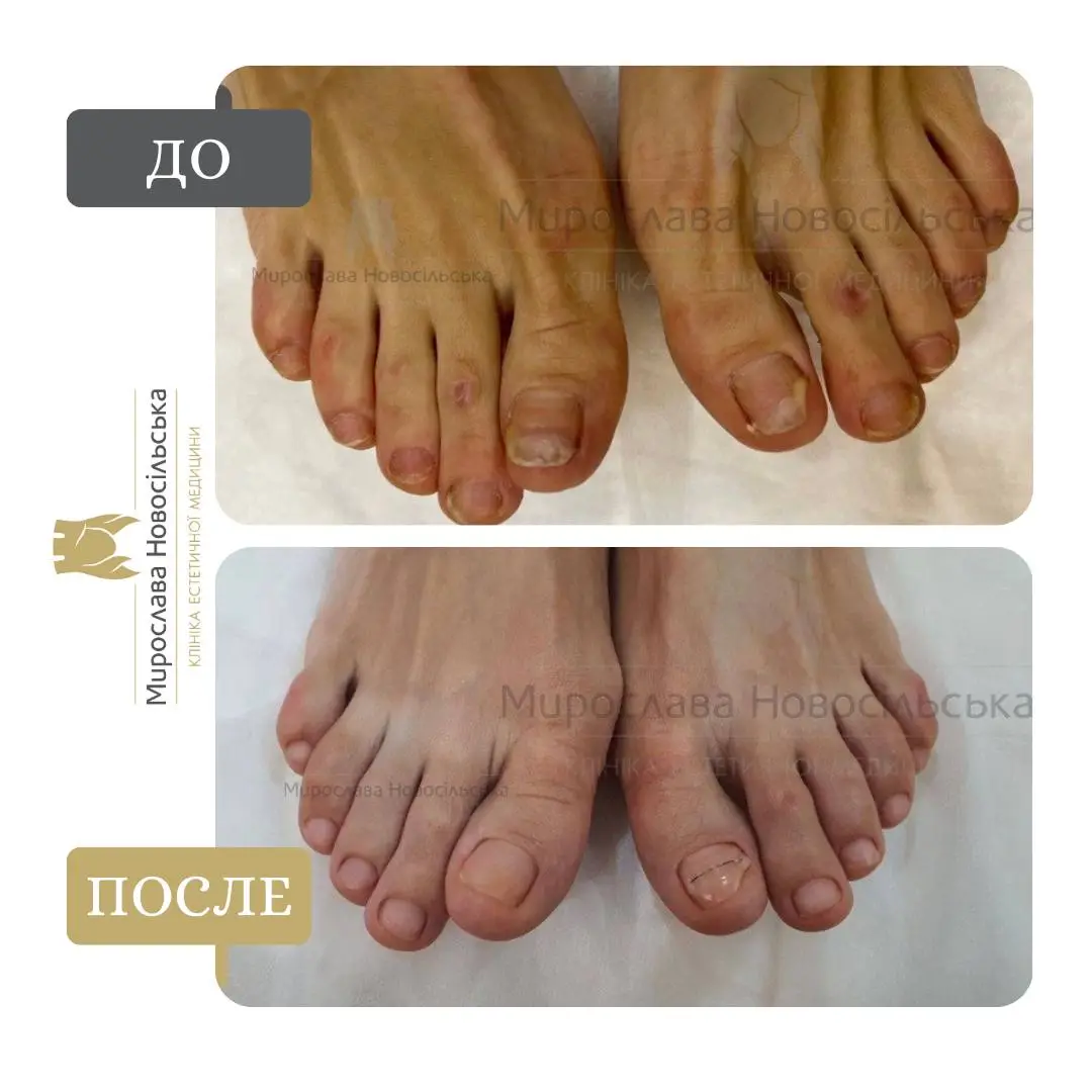 Лазерное лечение грибка, фото 9