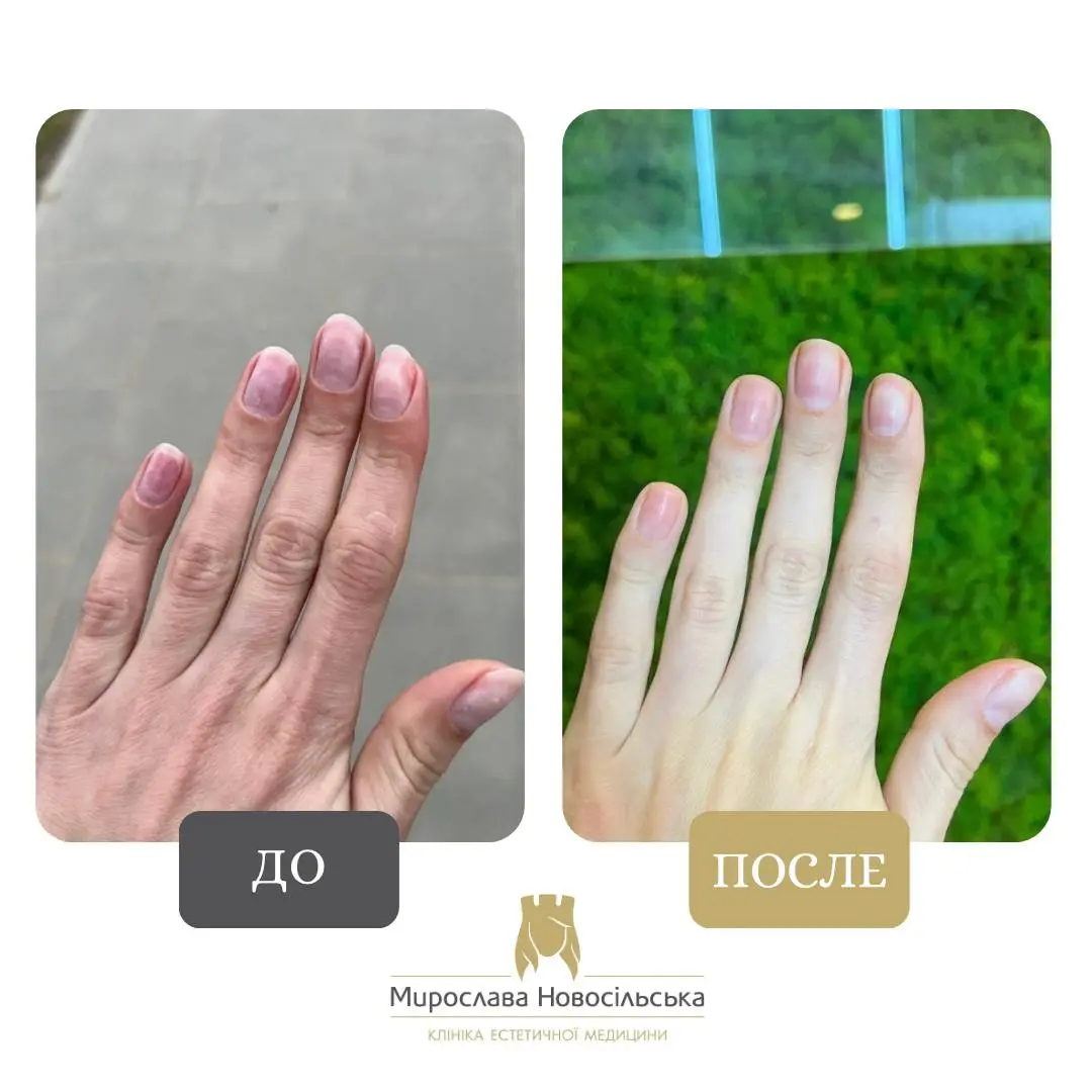 Лазерное лечение грибка, фото 12