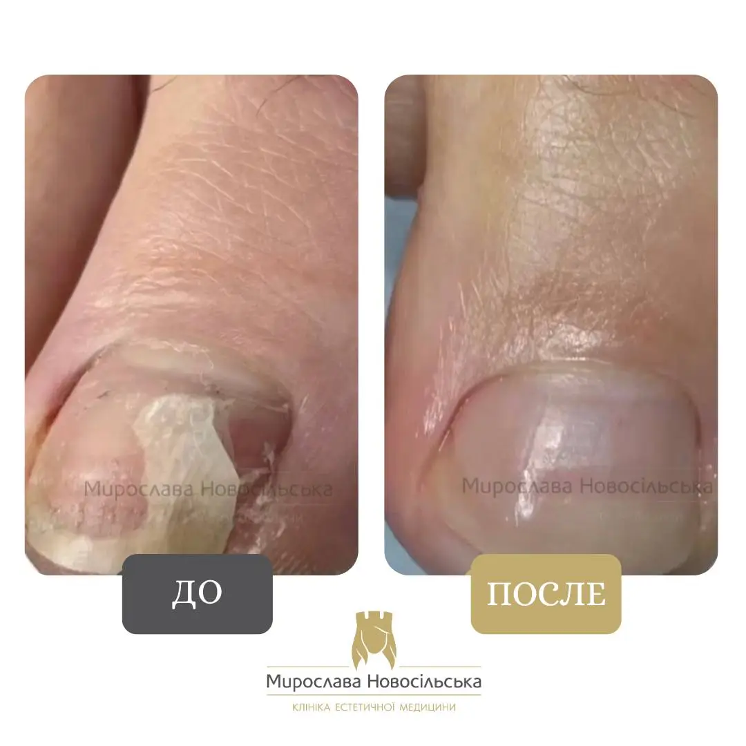 Лазерное лечение грибка, фото 15