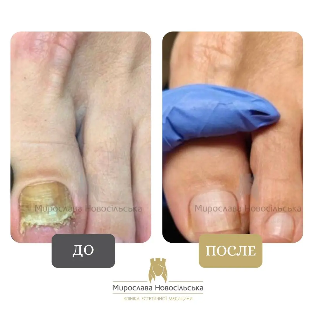 Лазерное лечение грибка, фото 17