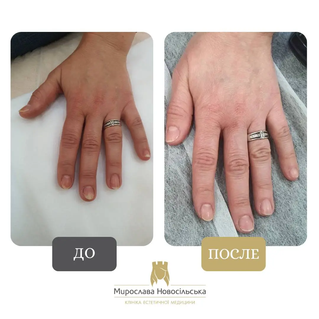 Лазерное лечение грибка, фото 11