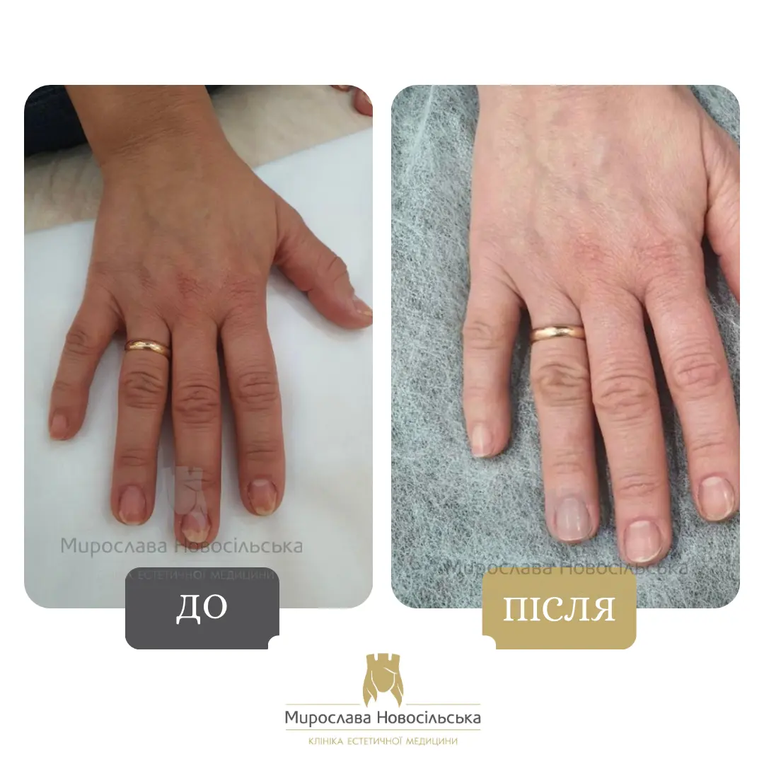 Лазерне лікування грибка, фото 10