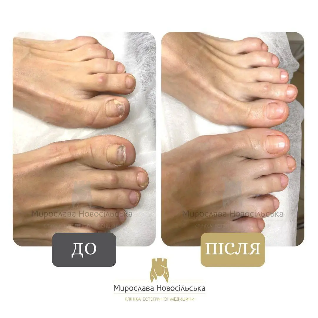 Лазерне лікування грибка, фото 8