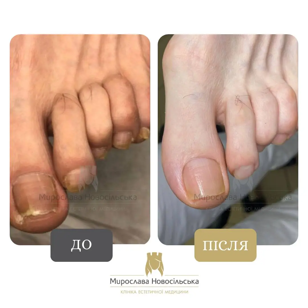 Лазерне лікування грибка, фото 13
