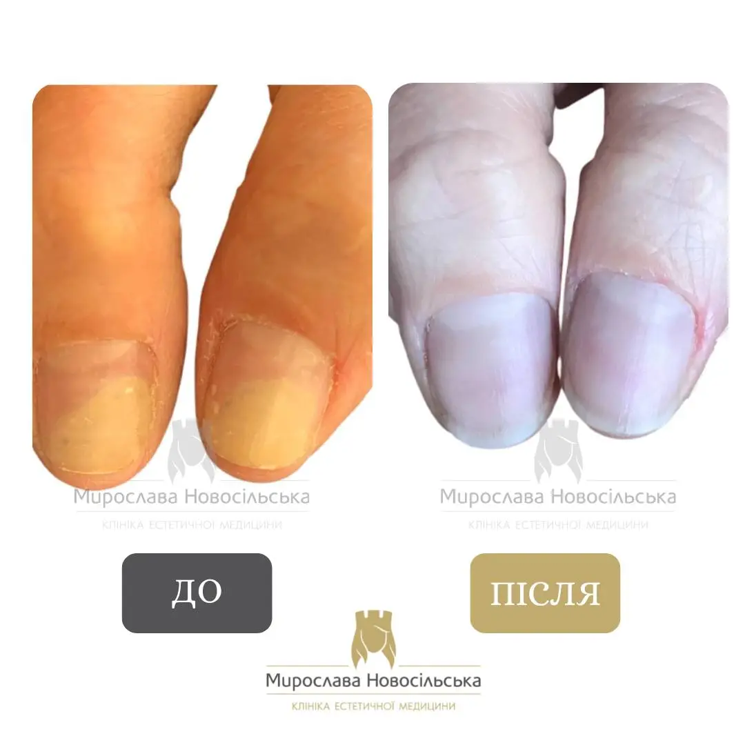 Лазерне лікування грибка, фото 16
