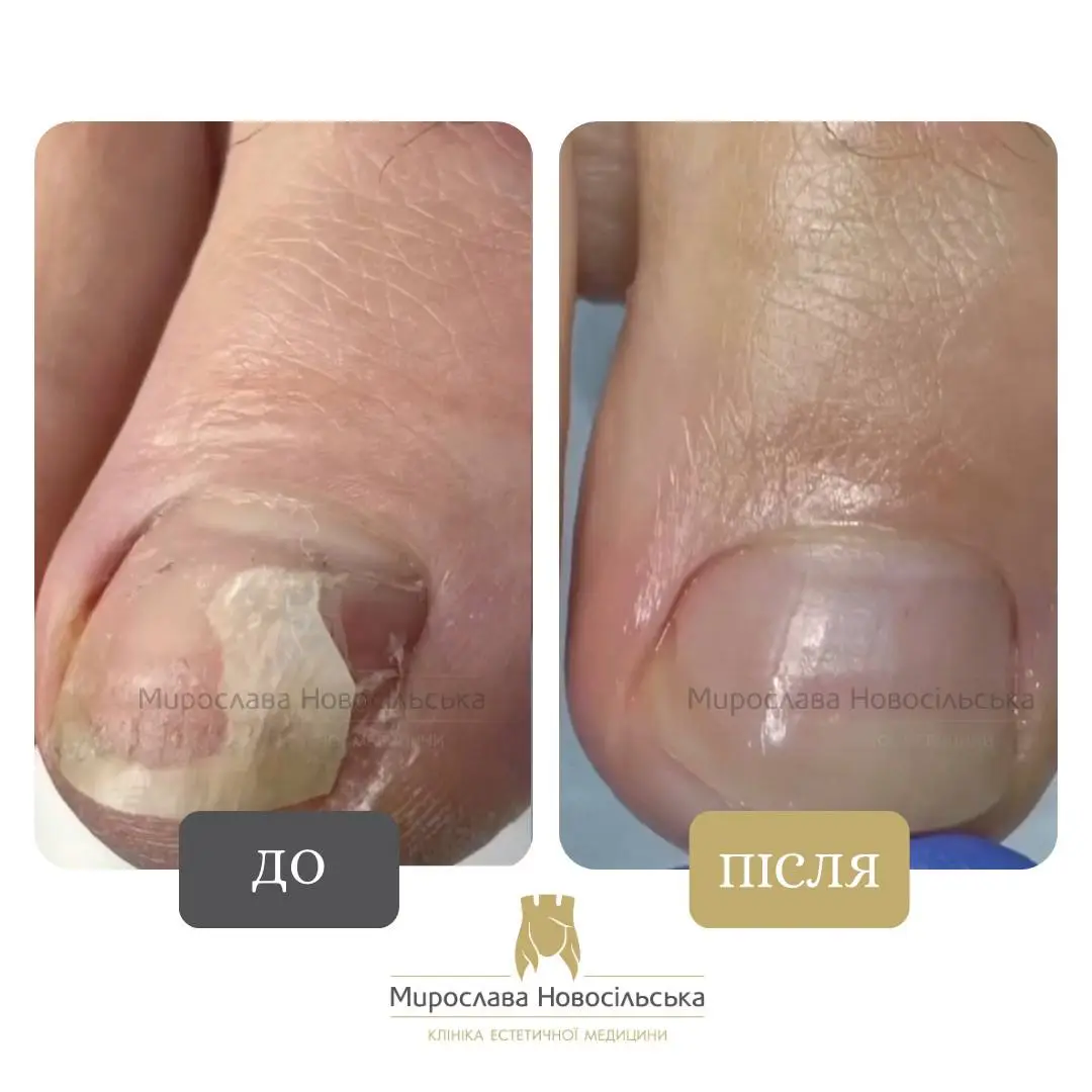 Лазерне лікування грибка, фото 15
