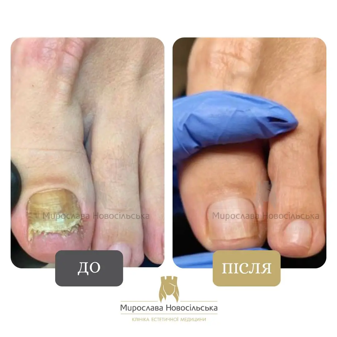 Лазерне лікування грибка, фото 17