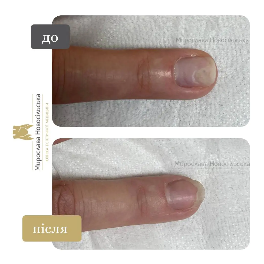 Лазерне лікування грибка, фото 18