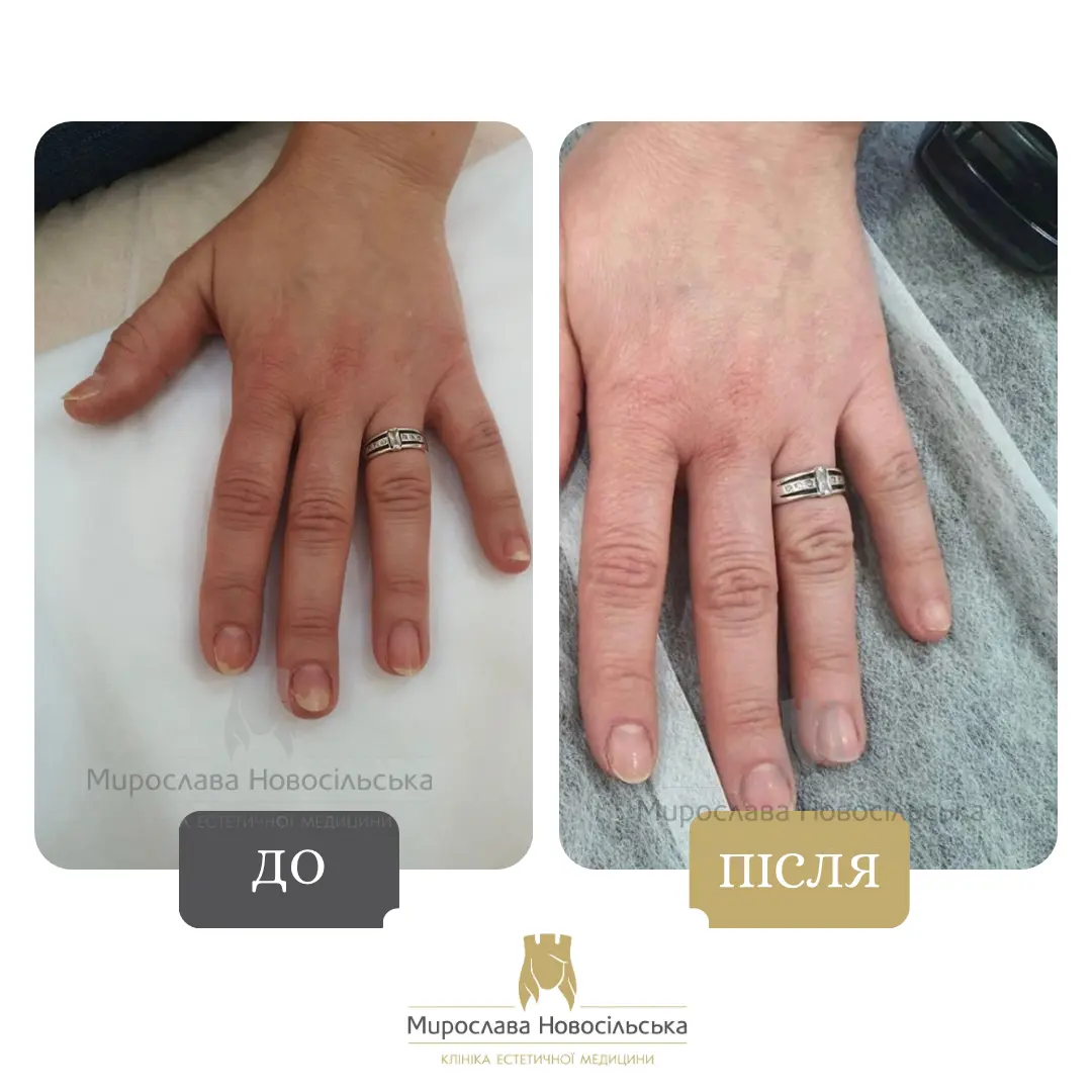 Лазерне лікування грибка, фото 11