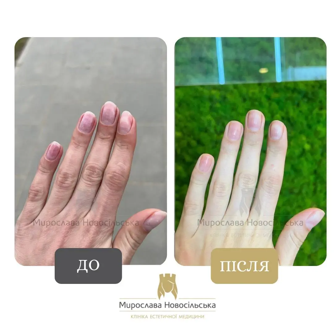 Лазерне лікування грибка, фото 12