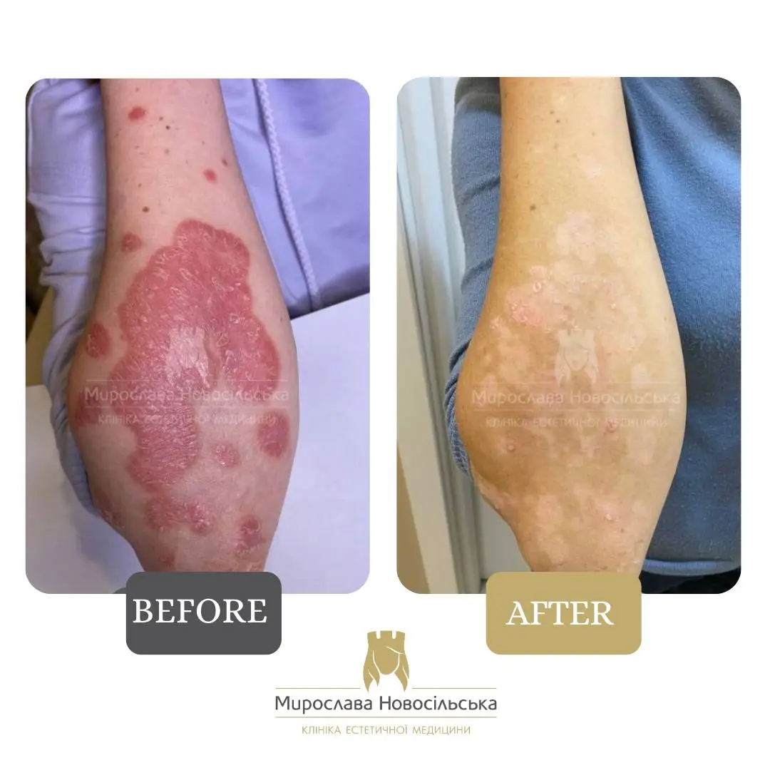 Laser treatment of psoriasis, photo 6