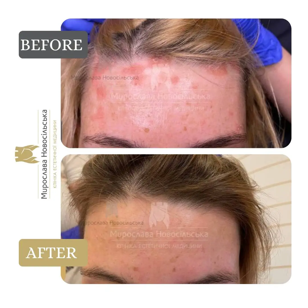 Laser treatment of psoriasis, photo 2