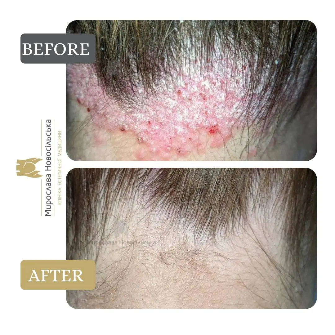 Laser treatment of psoriasis, photo 7
