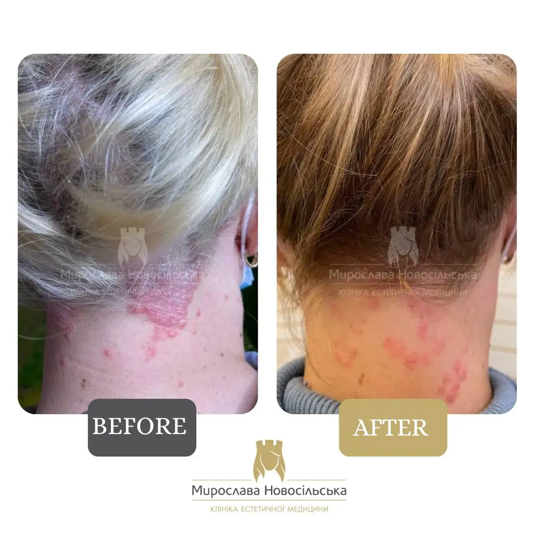 Laser treatment of psoriasis, photo 12