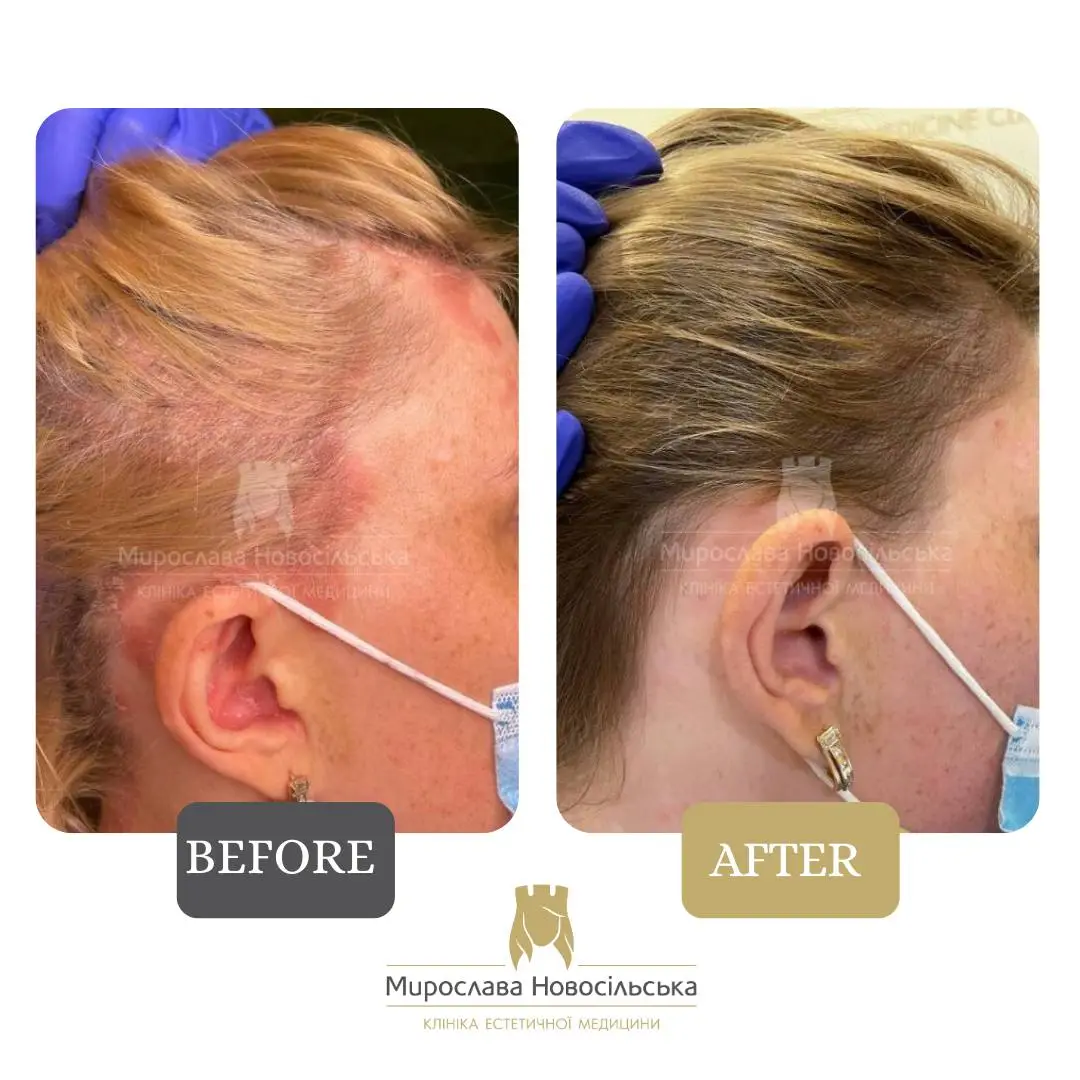 Laser treatment of psoriasis