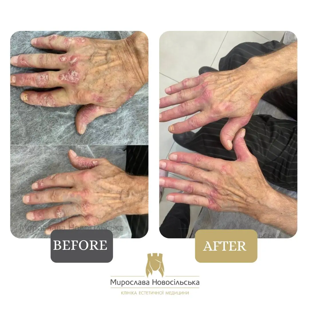 Laser treatment of psoriasis, photo 4