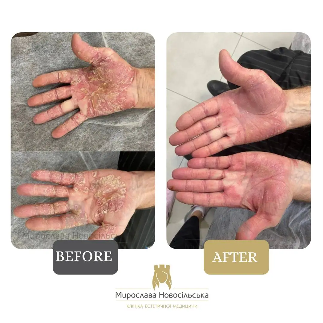 Laser treatment of psoriasis, photo 10