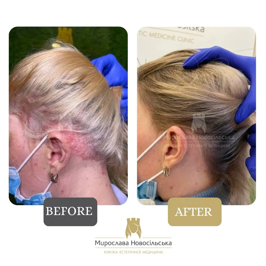 Laser treatment of psoriasis, photo 8