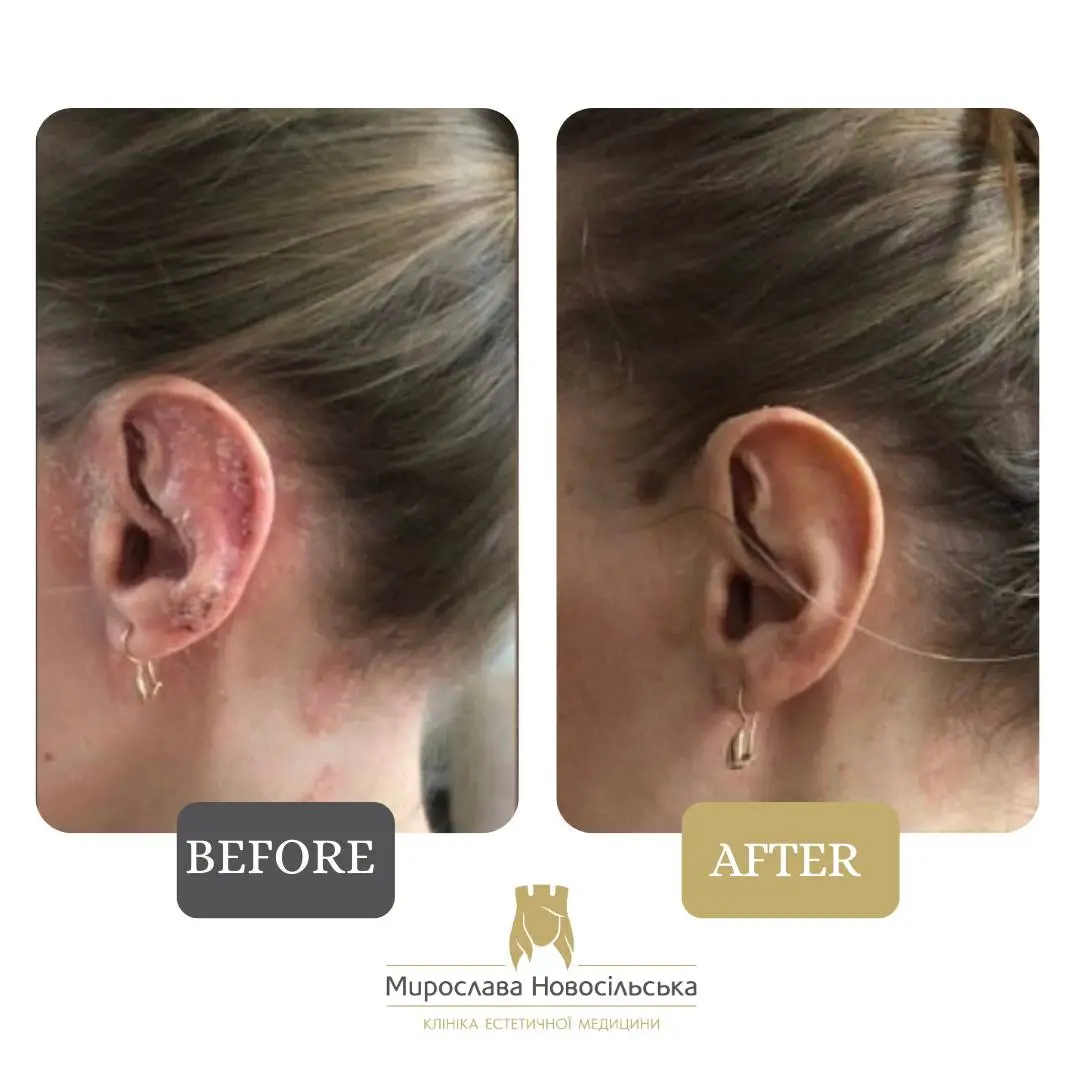 Laser treatment of psoriasis, photo 3