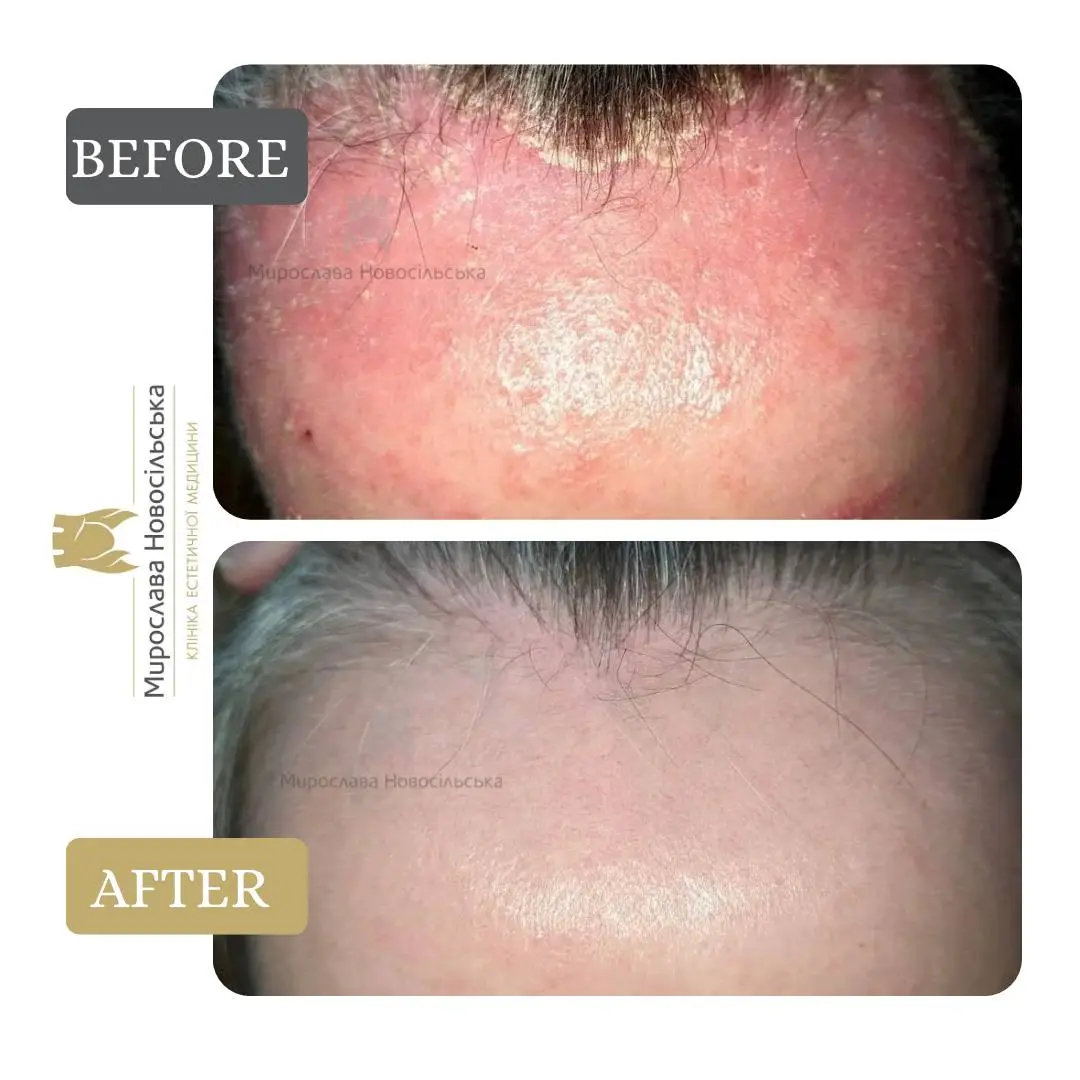 Laser treatment of psoriasis, photo 9