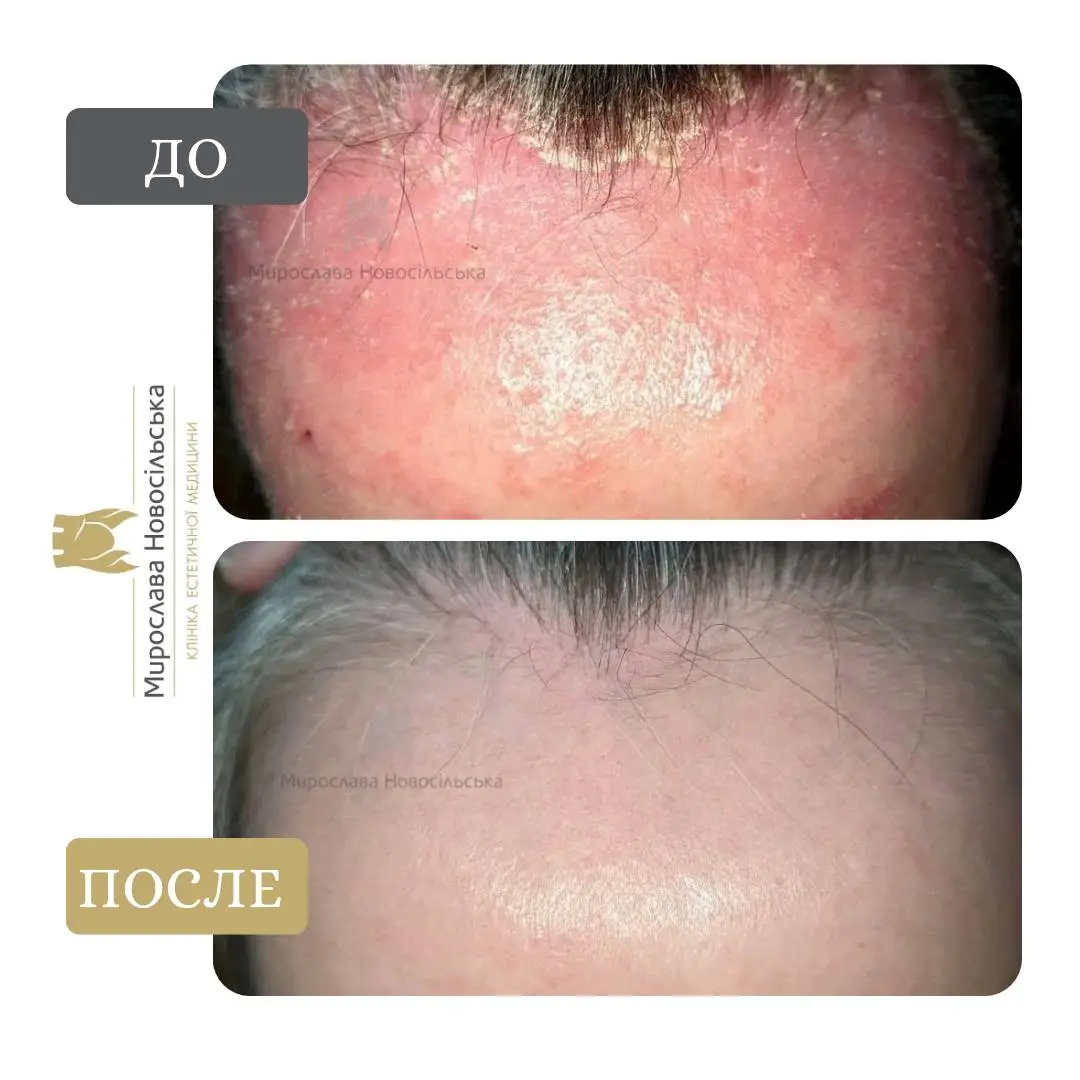 Лазерное лечение псориаза, фото 9