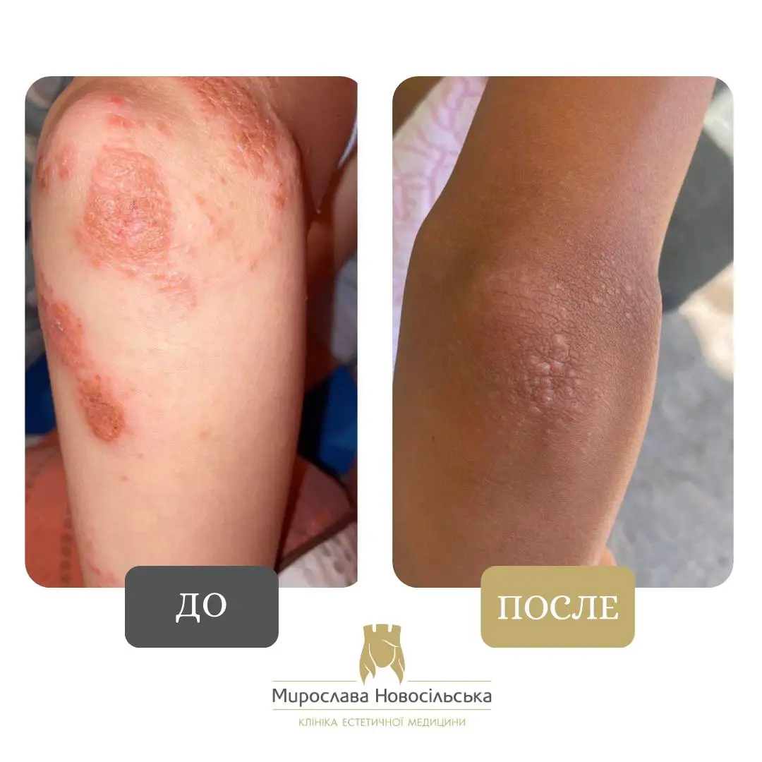 Лазерное лечение псориаза