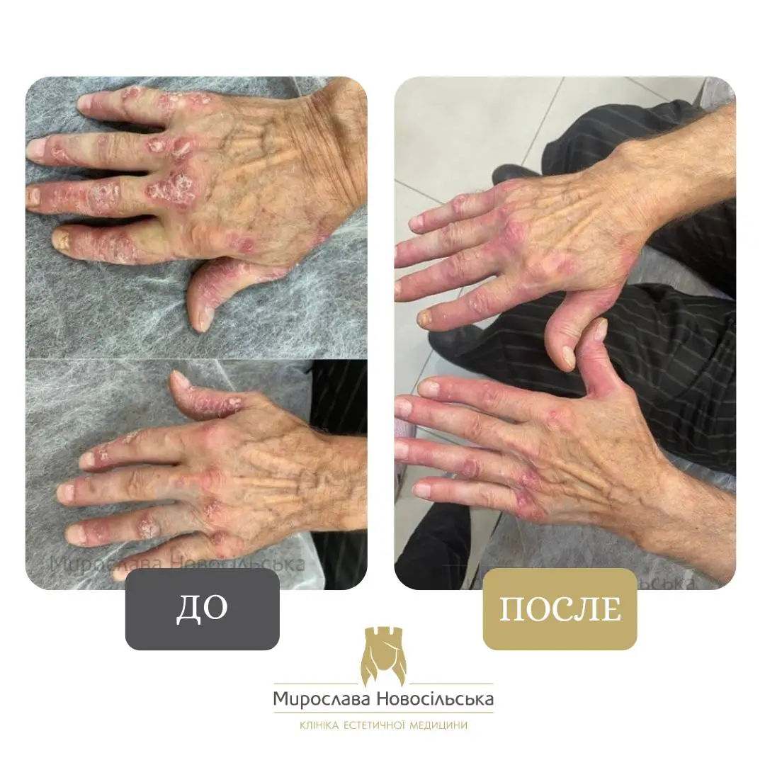 Лазерное лечение псориаза, фото 4